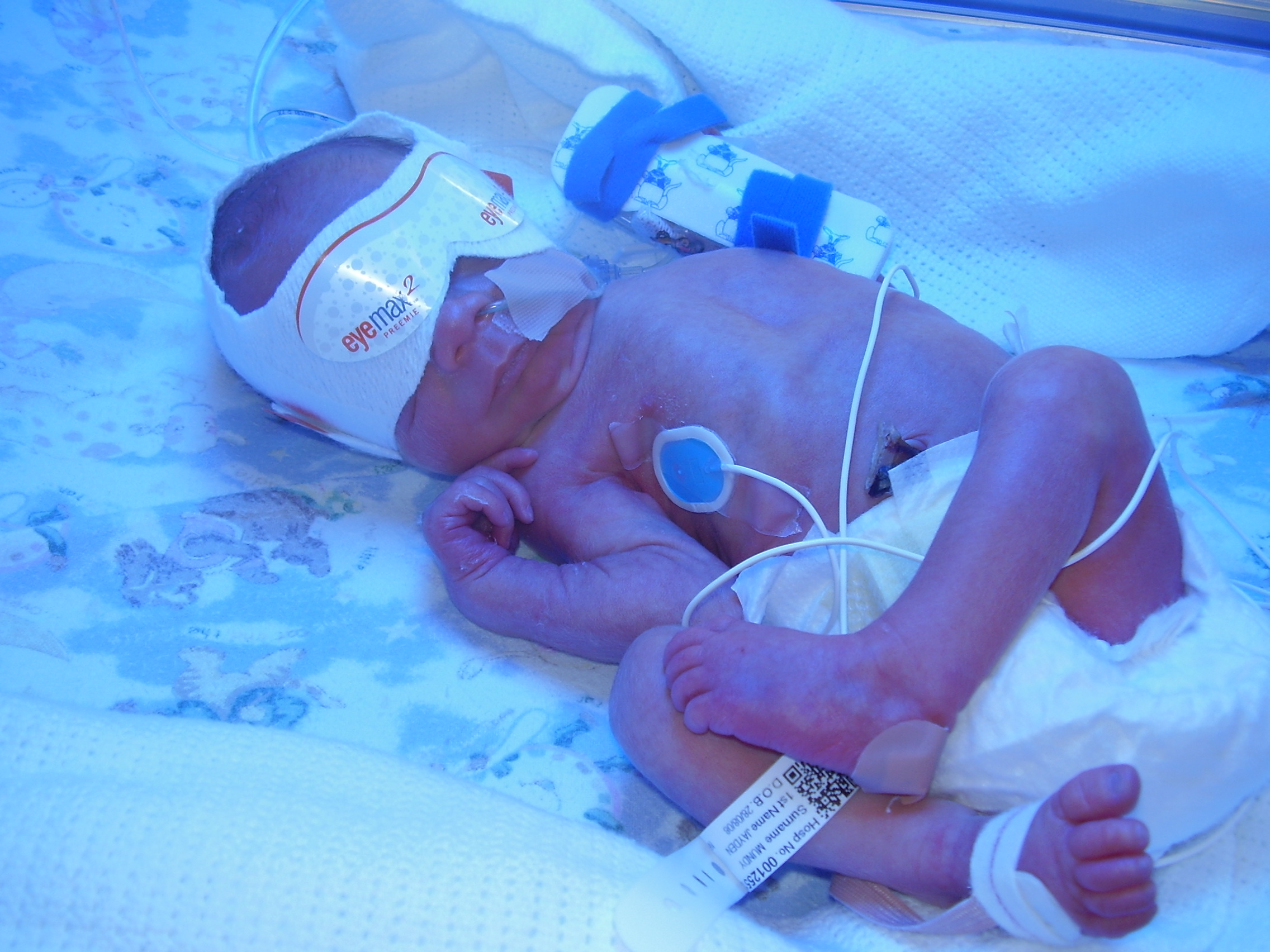 TERRIFIED OF HAVING ANOTHER PREMATURE BABY